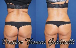 cliniques d abdominoplastie marseille Docteur Thomas Guidicelli, Chirurgien esthétique Marseille